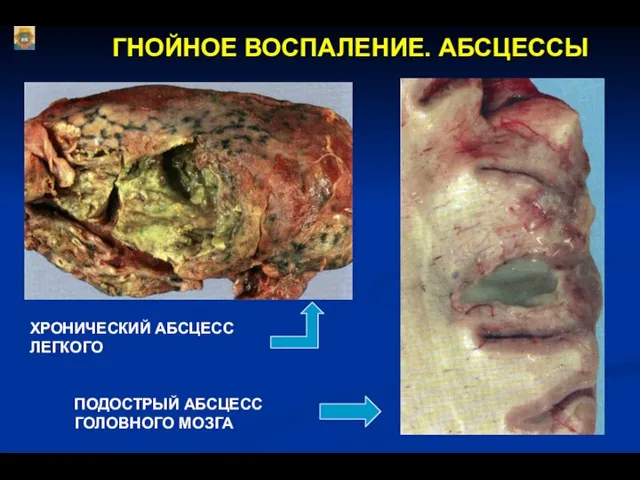 ГНОЙНОЕ ВОСПАЛЕНИЕ. АБСЦЕССЫ ХРОНИЧЕСКИЙ АБСЦЕСС ЛЕГКОГО ПОДОСТРЫЙ АБСЦЕСС ГОЛОВНОГО МОЗГА