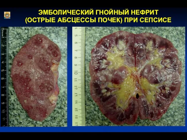 ЭМБОЛИЧЕСКИЙ ГНОЙНЫЙ НЕФРИТ (ОСТРЫЕ АБСЦЕССЫ ПОЧЕК) ПРИ СЕПСИСЕ