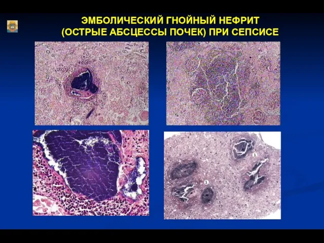 ЭМБОЛИЧЕСКИЙ ГНОЙНЫЙ НЕФРИТ (ОСТРЫЕ АБСЦЕССЫ ПОЧЕК) ПРИ СЕПСИСЕ