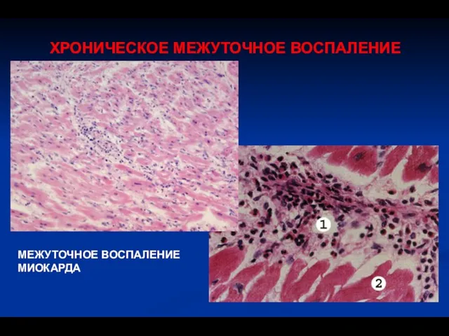 ХРОНИЧЕСКОЕ МЕЖУТОЧНОЕ ВОСПАЛЕНИЕ МЕЖУТОЧНОЕ ВОСПАЛЕНИЕ МИОКАРДА