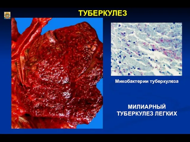 ТУБЕРКУЛЕЗ МИЛИАРНЫЙ ТУБЕРКУЛЕЗ ЛЕГКИХ Микобактерии туберкулеза