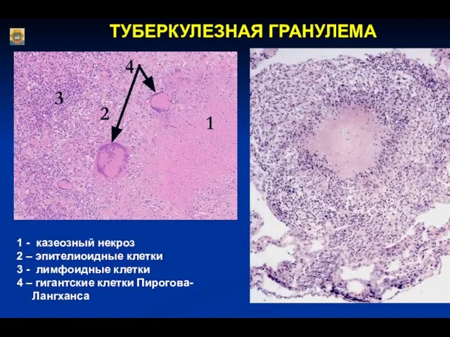 ТУБЕРКУЛЕЗНАЯ ГРАНУЛЕМА 1 2 3 1 - казеозный некроз 2 –