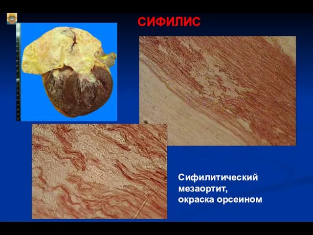 СИФИЛИС Сифилитический мезаортит, окраска орсеином