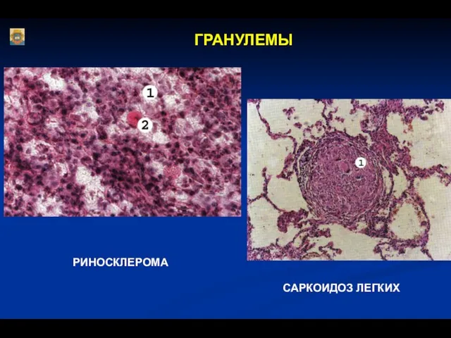 ГРАНУЛЕМЫ РИНОСКЛЕРОМА САРКОИДОЗ ЛЕГКИХ