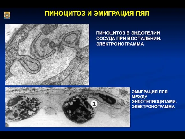 ПИНОЦИТОЗ И ЭМИГРАЦИЯ ПЯЛ ПИНОЦИТОЗ В ЭНДОТЕЛИИ СОСУДА ПРИ ВОСПАЛЕНИИ. ЭЛЕКТРОНОГРАММА ЭМИГРАЦИЯ ПЯЛ МЕЖДУ ЭНДОТЕЛИОЦИТАМИ. ЭЛЕКТРОНОГРАММА