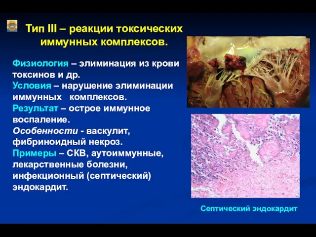 Тип III – реакции токсических иммунных комплексов. Физиология – элиминация из