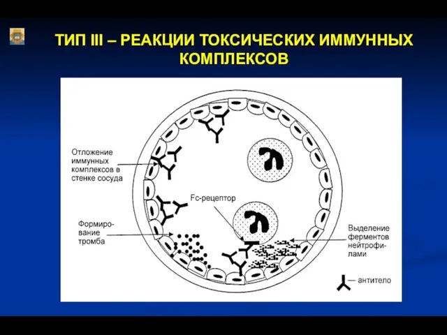 ТИП III – РЕАКЦИИ ТОКСИЧЕСКИХ ИММУННЫХ КОМПЛЕКСОВ