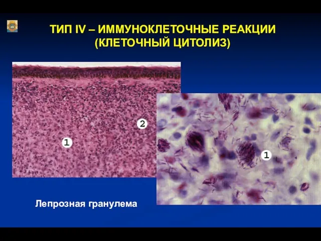 Лепрозная гранулема ТИП IV – ИММУНОКЛЕТОЧНЫЕ РЕАКЦИИ (КЛЕТОЧНЫЙ ЦИТОЛИЗ)