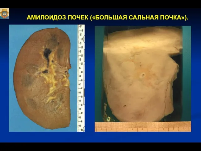 АМИЛОИДОЗ ПОЧЕК («БОЛЬШАЯ САЛЬНАЯ ПОЧКА»).