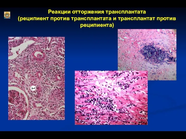 Реакции отторжения трансплантата (реципиент против трансплантата и трансплантат против реципиента)