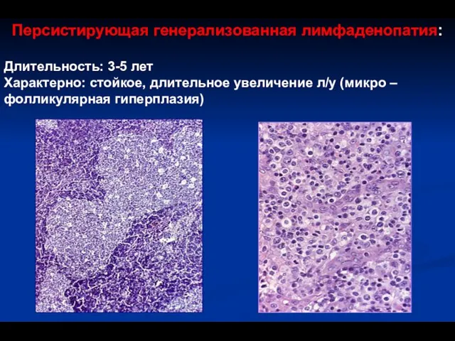 Персистирующая генерализованная лимфаденопатия: Длительность: 3-5 лет Характерно: стойкое, длительное увеличение л/у (микро – фолликулярная гиперплазия)