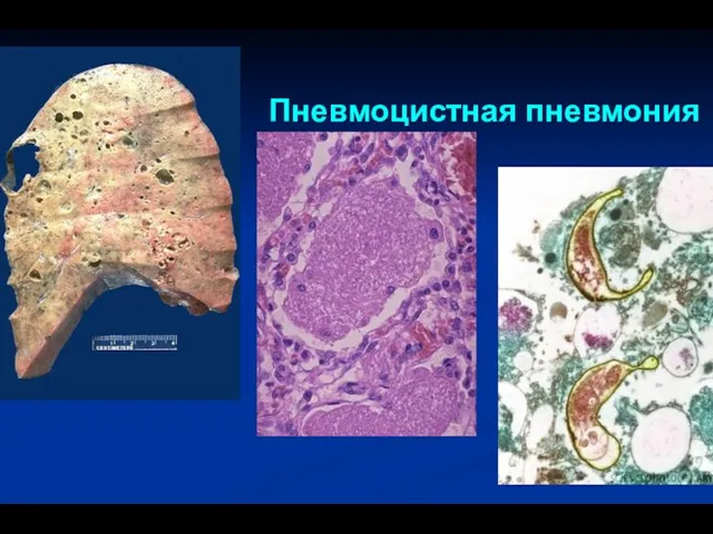 Пневмоцистная пневмония