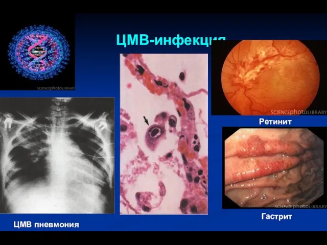 ЦМВ-инфекция Гастрит Ретинит ЦМВ пневмония