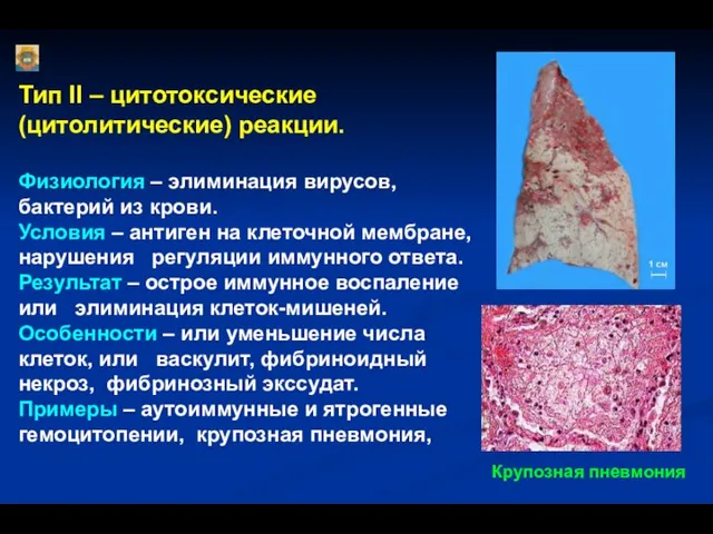 Тип II – цитотоксические (цитолитические) реакции. Физиология – элиминация вирусов, бактерий