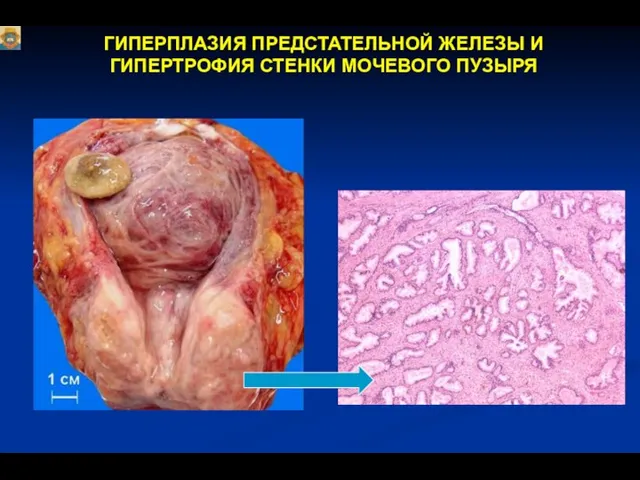 ГИПЕРПЛАЗИЯ ПРЕДСТАТЕЛЬНОЙ ЖЕЛЕЗЫ И ГИПЕРТРОФИЯ СТЕНКИ МОЧЕВОГО ПУЗЫРЯ