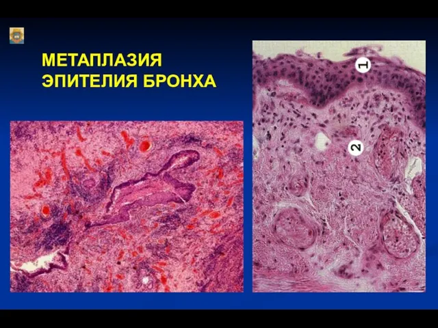 МЕТАПЛАЗИЯ ЭПИТЕЛИЯ БРОНХА