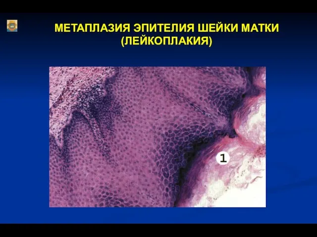 МЕТАПЛАЗИЯ ЭПИТЕЛИЯ ШЕЙКИ МАТКИ (ЛЕЙКОПЛАКИЯ)