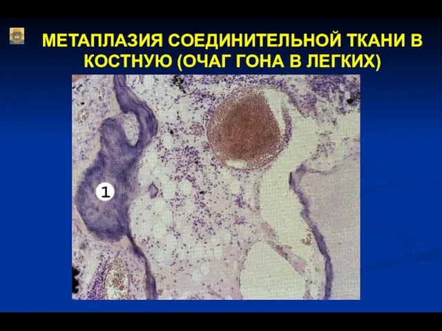 МЕТАПЛАЗИЯ СОЕДИНИТЕЛЬНОЙ ТКАНИ В КОСТНУЮ (ОЧАГ ГОНА В ЛЕГКИХ)