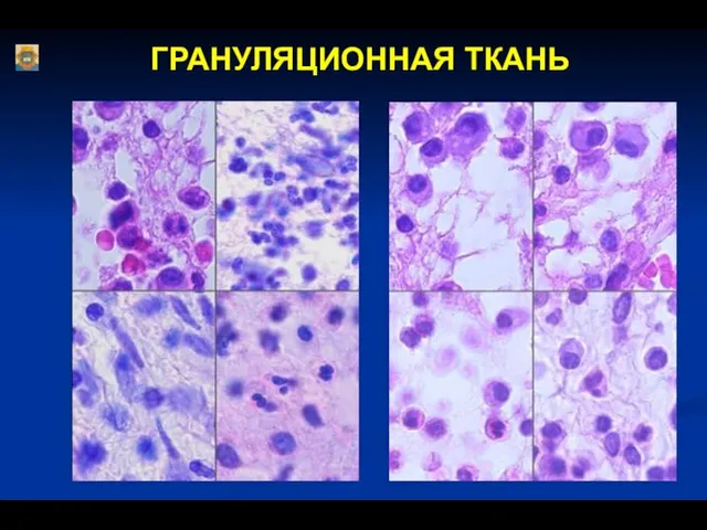 ГРАНУЛЯЦИОННАЯ ТКАНЬ