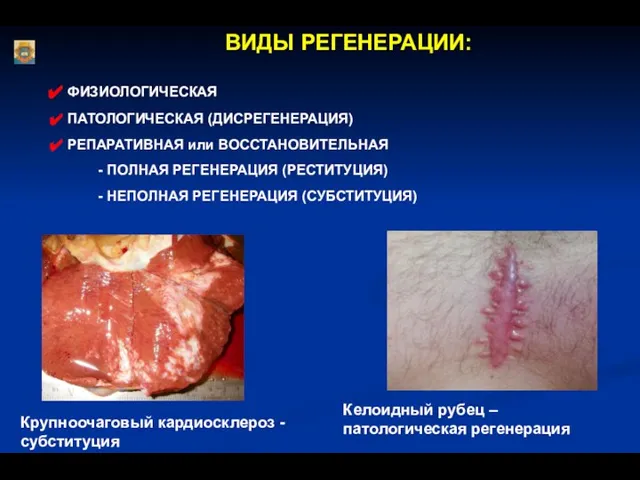ВИДЫ РЕГЕНЕРАЦИИ: ФИЗИОЛОГИЧЕСКАЯ ПАТОЛОГИЧЕСКАЯ (ДИСРЕГЕНЕРАЦИЯ) РЕПАРАТИВНАЯ или ВОССТАНОВИТЕЛЬНАЯ - ПОЛНАЯ РЕГЕНЕРАЦИЯ
