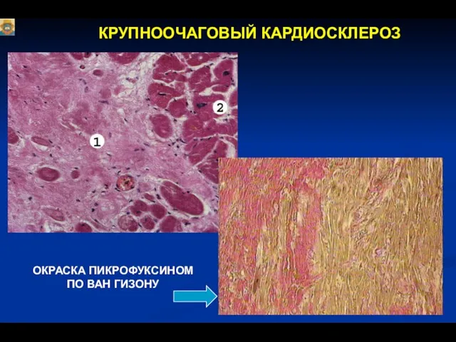 КРУПНООЧАГОВЫЙ КАРДИОСКЛЕРОЗ ОКРАСКА ПИКРОФУКСИНОМ ПО ВАН ГИЗОНУ