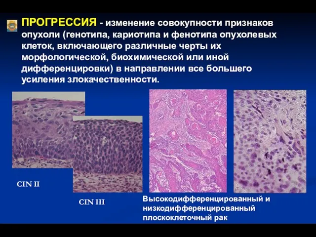 ПРОГРЕССИЯ - изменение совокупности признаков опухоли (генотипа, кариотипа и фенотипа опухолевых