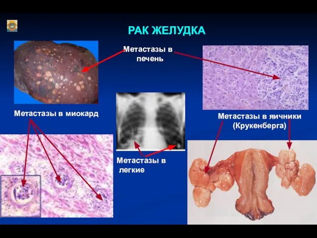 РАК ЖЕЛУДКА Метастазы в печень Метастазы в миокард Метастазы в яичники (Крукенберга) Метастазы в легкие