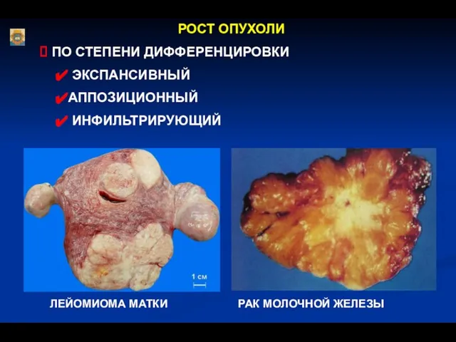РОСТ ОПУХОЛИ ПО СТЕПЕНИ ДИФФЕРЕНЦИРОВКИ ЭКСПАНСИВНЫЙ АППОЗИЦИОННЫЙ ИНФИЛЬТРИРУЮЩИЙ РАК МОЛОЧНОЙ ЖЕЛЕЗЫ ЛЕЙОМИОМА МАТКИ