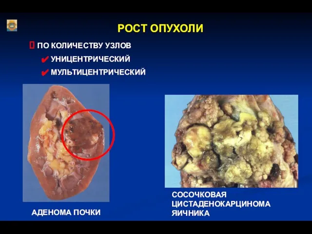 РОСТ ОПУХОЛИ ПО КОЛИЧЕСТВУ УЗЛОВ УНИЦЕНТРИЧЕСКИЙ МУЛЬТИЦЕНТРИЧЕСКИЙ СОСОЧКОВАЯ ЦИСТАДЕНОКАРЦИНОМА ЯИЧНИКА АДЕНОМА ПОЧКИ