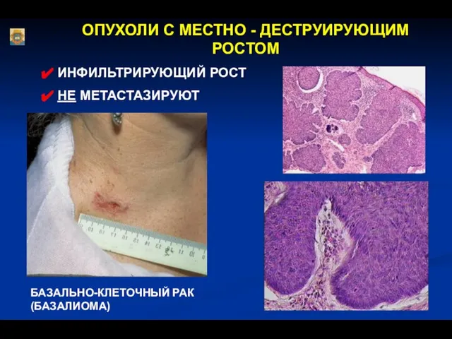 ОПУХОЛИ С МЕСТНО - ДЕСТРУИРУЮЩИМ РОСТОМ ИНФИЛЬТРИРУЮЩИЙ РОСТ НЕ МЕТАСТАЗИРУЮТ БАЗАЛЬНО-КЛЕТОЧНЫЙ РАК (БАЗАЛИОМА)