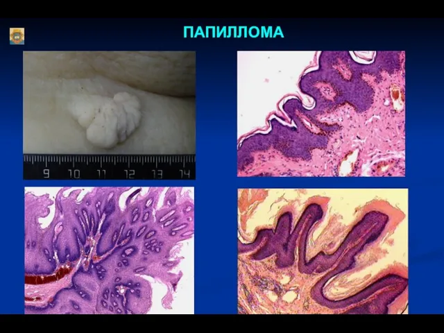 ПАПИЛЛОМА