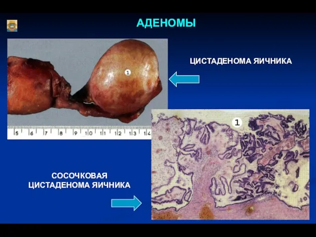 АДЕНОМЫ ЦИСТАДЕНОМА ЯИЧНИКА СОСОЧКОВАЯ ЦИСТАДЕНОМА ЯИЧНИКА