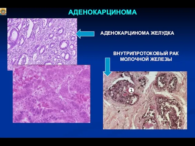 АДЕНОКАРЦИНОМА АДЕНОКАРЦИНОМА ЖЕЛУДКА ВНУТРИПРОТОКОВЫЙ РАК МОЛОЧНОЙ ЖЕЛЕЗЫ