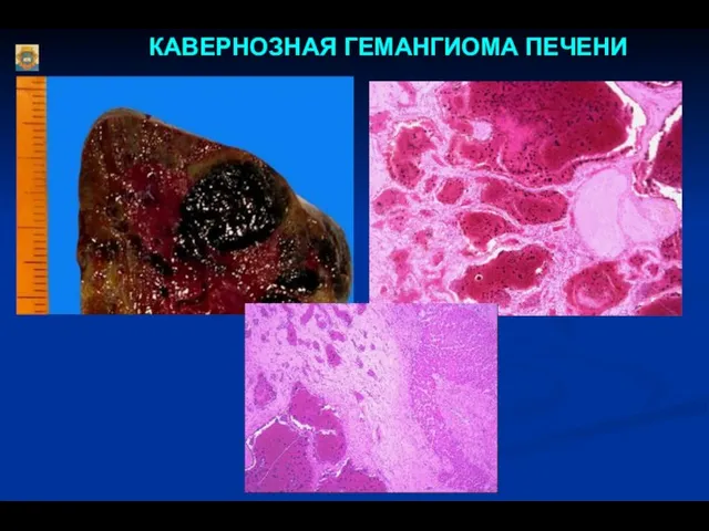 КАВЕРНОЗНАЯ ГЕМАНГИОМА ПЕЧЕНИ