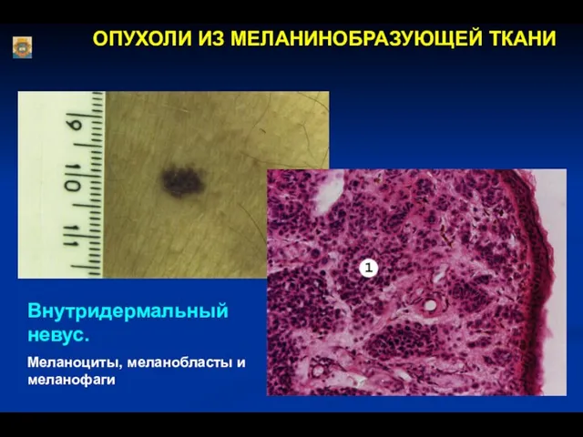 ОПУХОЛИ ИЗ МЕЛАНИНОБРАЗУЮЩЕЙ ТКАНИ Внутридермальный невус. Меланоциты, меланобласты и меланофаги