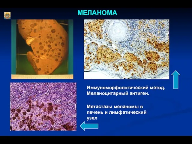 Иммуноморфологический метод. Меланоцитарный антиген. МЕЛАНОМА Метастазы меланомы в печень и лимфатический узел