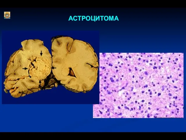 АСТРОЦИТОМА