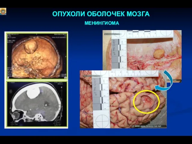 ОПУХОЛИ ОБОЛОЧЕК МОЗГА МЕНИНГИОМА