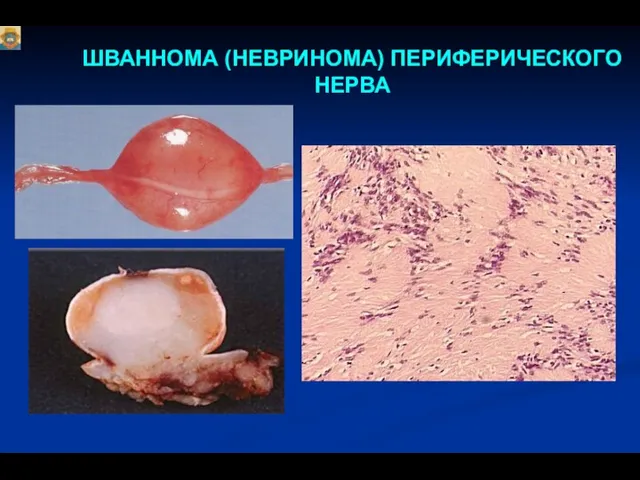 ШВАННОМА (НЕВРИНОМА) ПЕРИФЕРИЧЕСКОГО НЕРВА