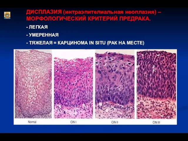 ДИСПЛАЗИЯ (интраэпителиальная неоплазия) – МОРФОЛОГИЧЕСКИЙ КРИТЕРИЙ ПРЕДРАКА. - ЛЕГКАЯ - УМЕРЕННАЯ