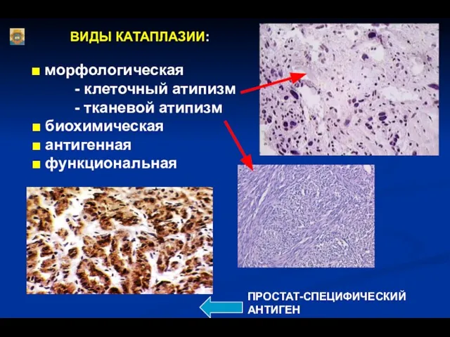 ВИДЫ КАТАПЛАЗИИ: ■ морфологическая - клеточный атипизм - тканевой атипизм ■