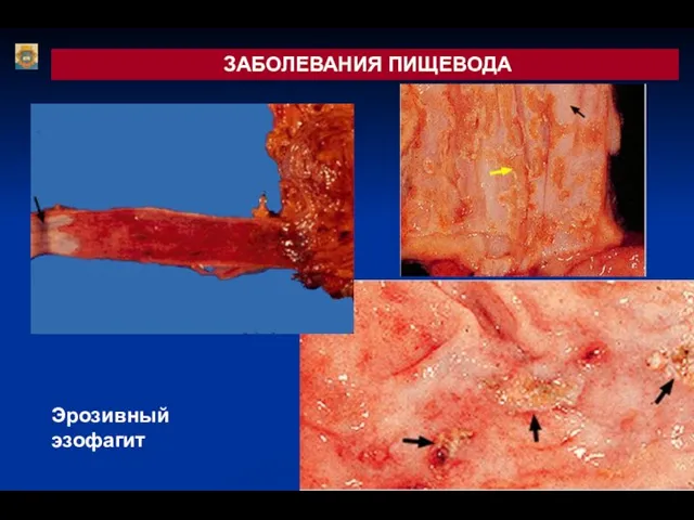 ЗАБОЛЕВАНИЯ ПИЩЕВОДА Эрозивный эзофагит