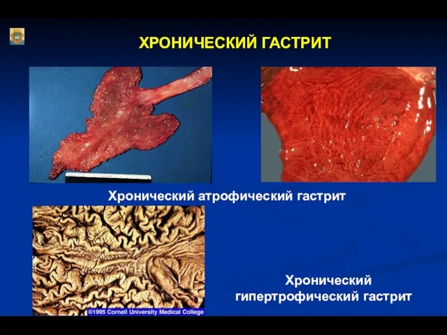 ХРОНИЧЕСКИЙ ГАСТРИТ Хронический атрофический гастрит Хронический гипертрофический гастрит