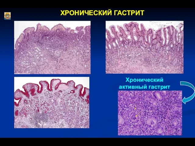 ХРОНИЧЕСКИЙ ГАСТРИТ Хронический активный гастрит