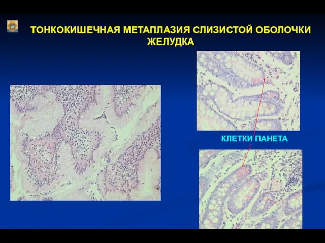 ТОНКОКИШЕЧНАЯ МЕТАПЛАЗИЯ СЛИЗИСТОЙ ОБОЛОЧКИ ЖЕЛУДКА КЛЕТКИ ПАНЕТА