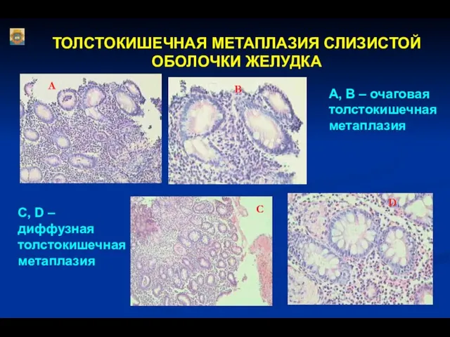 ТОЛСТОКИШЕЧНАЯ МЕТАПЛАЗИЯ СЛИЗИСТОЙ ОБОЛОЧКИ ЖЕЛУДКА А В С D А, В