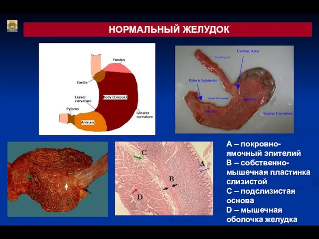 НОРМАЛЬНЫЙ ЖЕЛУДОК А В С D А – покровно-ямочный эпителий В