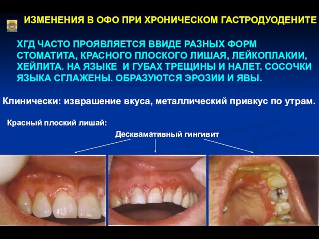 ИЗМЕНЕНИЯ В ОФО ПРИ ХРОНИЧЕСКОМ ГАСТРОДУОДЕНИТЕ ХГД ЧАСТО ПРОЯВЛЯЕТСЯ ВВИДЕ РАЗНЫХ