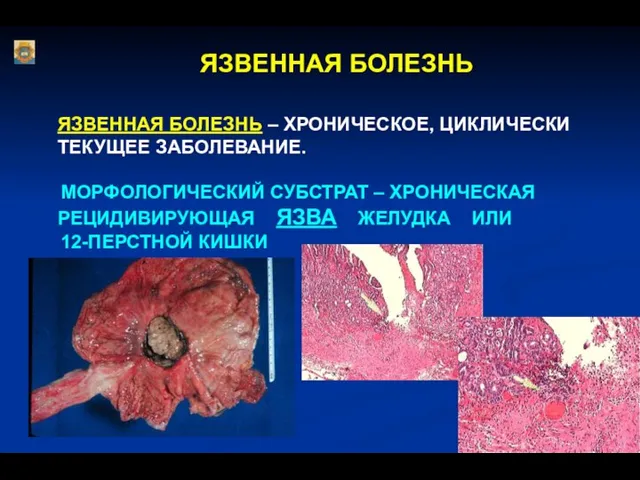 ЯЗВЕННАЯ БОЛЕЗНЬ ЯЗВЕННАЯ БОЛЕЗНЬ – ХРОНИЧЕСКОЕ, ЦИКЛИЧЕСКИ ТЕКУЩЕЕ ЗАБОЛЕВАНИЕ. МОРФОЛОГИЧЕСКИЙ СУБСТРАТ