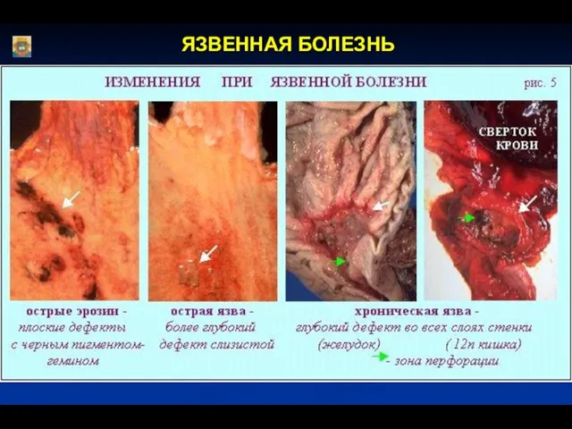 ЯЗВЕННАЯ БОЛЕЗНЬ